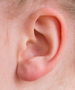 Sensitive Ears: Hyperacusis